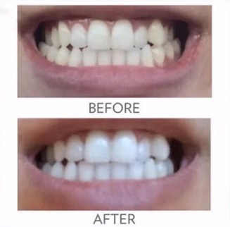 ap 24_whitening_toothpaste_before_after